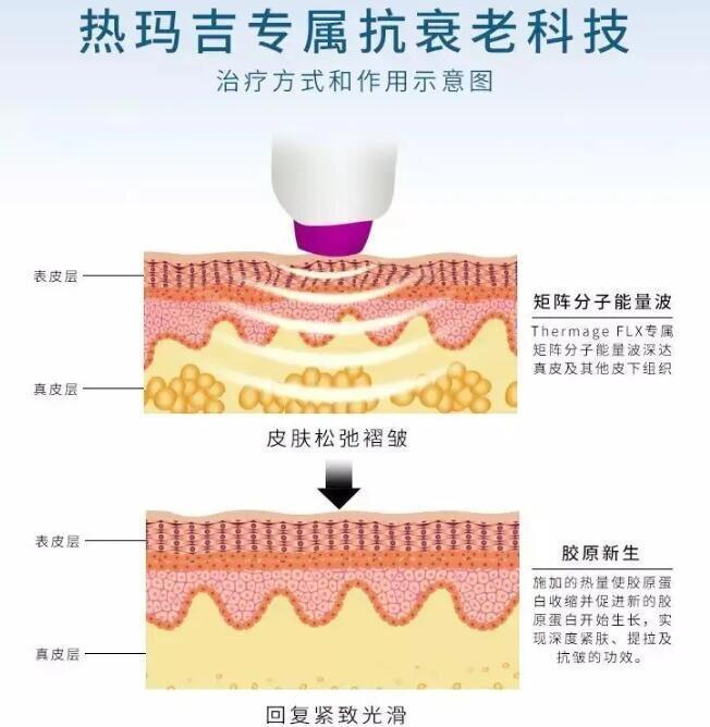 热玛吉是什么、热玛吉适合多大年龄做~当妈妈了还能做吗(图8)