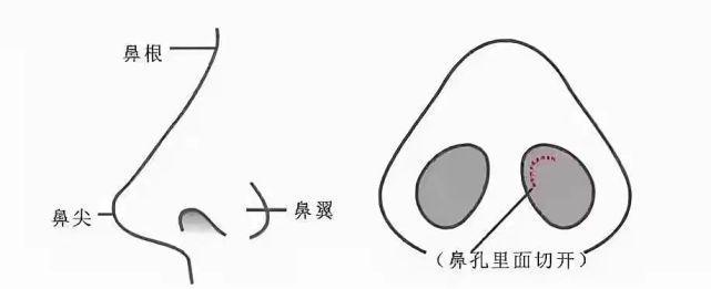 钟辉：隆鼻中硅胶和膨体的区别有哪些？丨科普篇(图2)