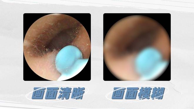 可视掏耳勺好用吗安全吗？推荐10款高性价比可视掏耳勺机型！(图15)