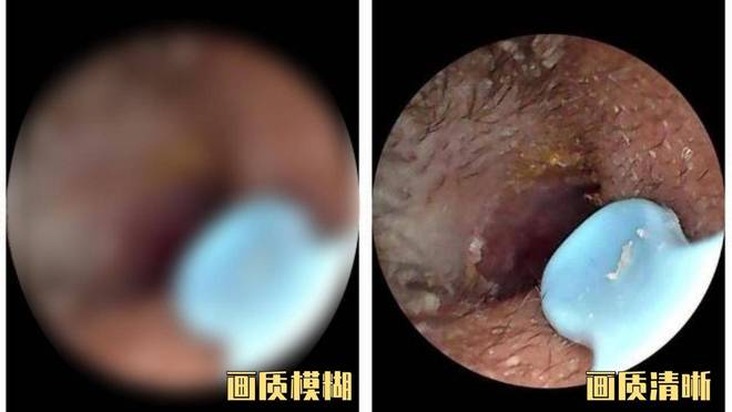 可视掏耳勺哪种好？2025可视掏耳勺10款高性价比推荐(图6)