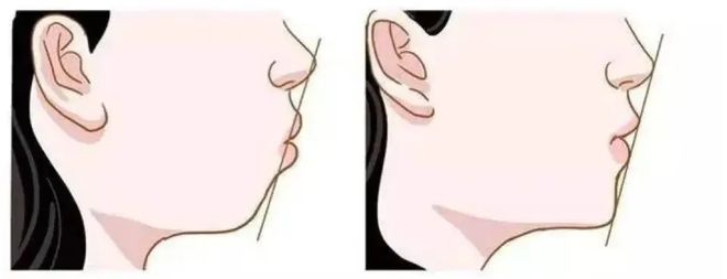 因为一个坏习惯多少人“失去了下巴”(图2)